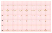 HTML5 Canvas心电图波浪线特效